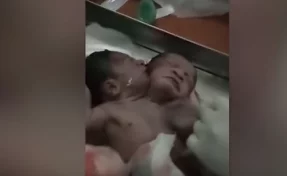 В Индии родился уникальный ребёнок с двумя головами