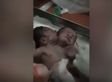 Фото: В Индии родился уникальный ребёнок с двумя головами 1