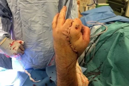 Фото: Врачи пришили отпиленную руку к паху пациента 2