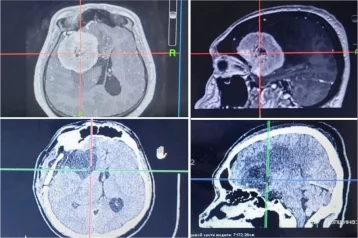 Фото: В Кузбассе нейрохирурги 5 часов спасали пациента с опухолью головного мозга 2