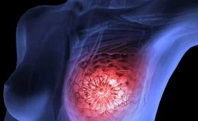 Главный онколог Минздрава рассказал о шансах вылечить рак молочной железы
