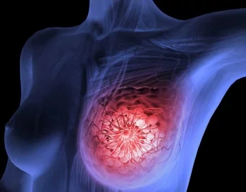 Фото: Главный онколог Минздрава рассказал о шансах вылечить рак молочной железы 1