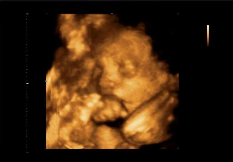 Фото: 3D и 4D УЗИ при беременности: как получить фото и видео с ребёнком до родов 3