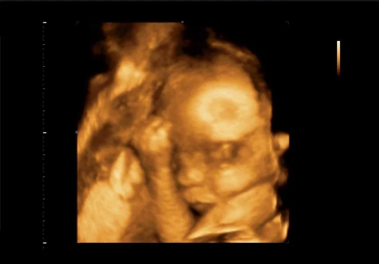 Фото: 3D и 4D УЗИ при беременности: как получить фото и видео с ребёнком до родов 4