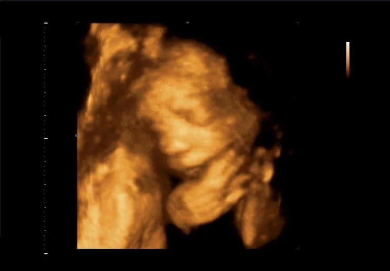 Фото: 3D и 4D УЗИ при беременности: как получить фото и видео с ребёнком до родов 5