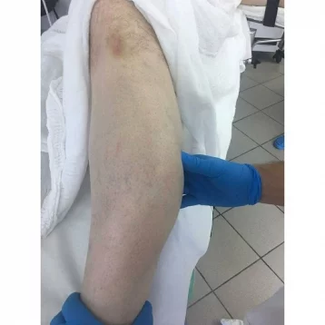 Фото: В Кемерове прооперировали мужчину, который три года не замечал опухоль в ноге 1