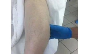 В Кемерове прооперировали мужчину, который три года не замечал опухоль в ноге