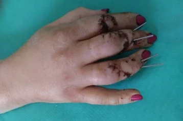 Фото: Новокузнечанка отрезала себе пальцы рук циркулярной пилой 1