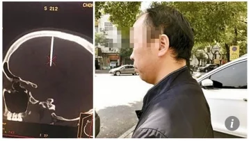 Фото: Мистика: у жителя Китая в голове появился пятисантиметровый гвоздь 1
