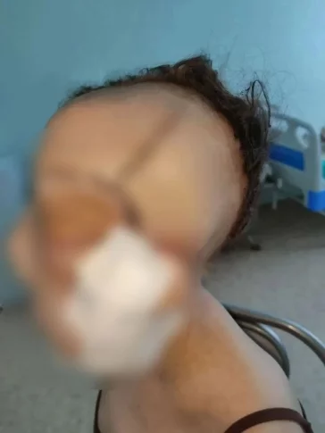 Фото: Кузбасские врачи удалили с лица девушки редкую опухоль весом 5 кг 2