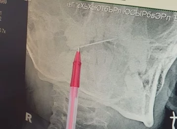 Фото: В Кемерове девочка засунула в нос иголку, ребёнка прооперировали 1