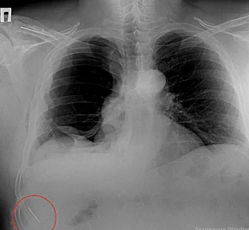 Фото: Установленная для лечения хирургическая спица едва не проткнула лёгкое кемеровчанину спустя 12 лет 1