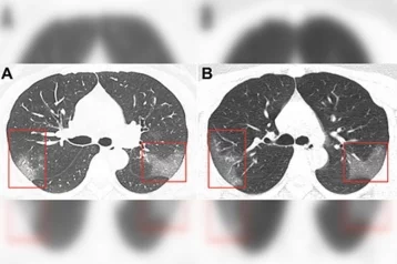 Фото: Медики показали снимки поражённых коронавирусом лёгких 1