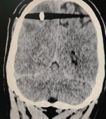 Фото: В Подмосковье врачи вытащили из мозга мужчины пулю, полученную по неосторожности  1